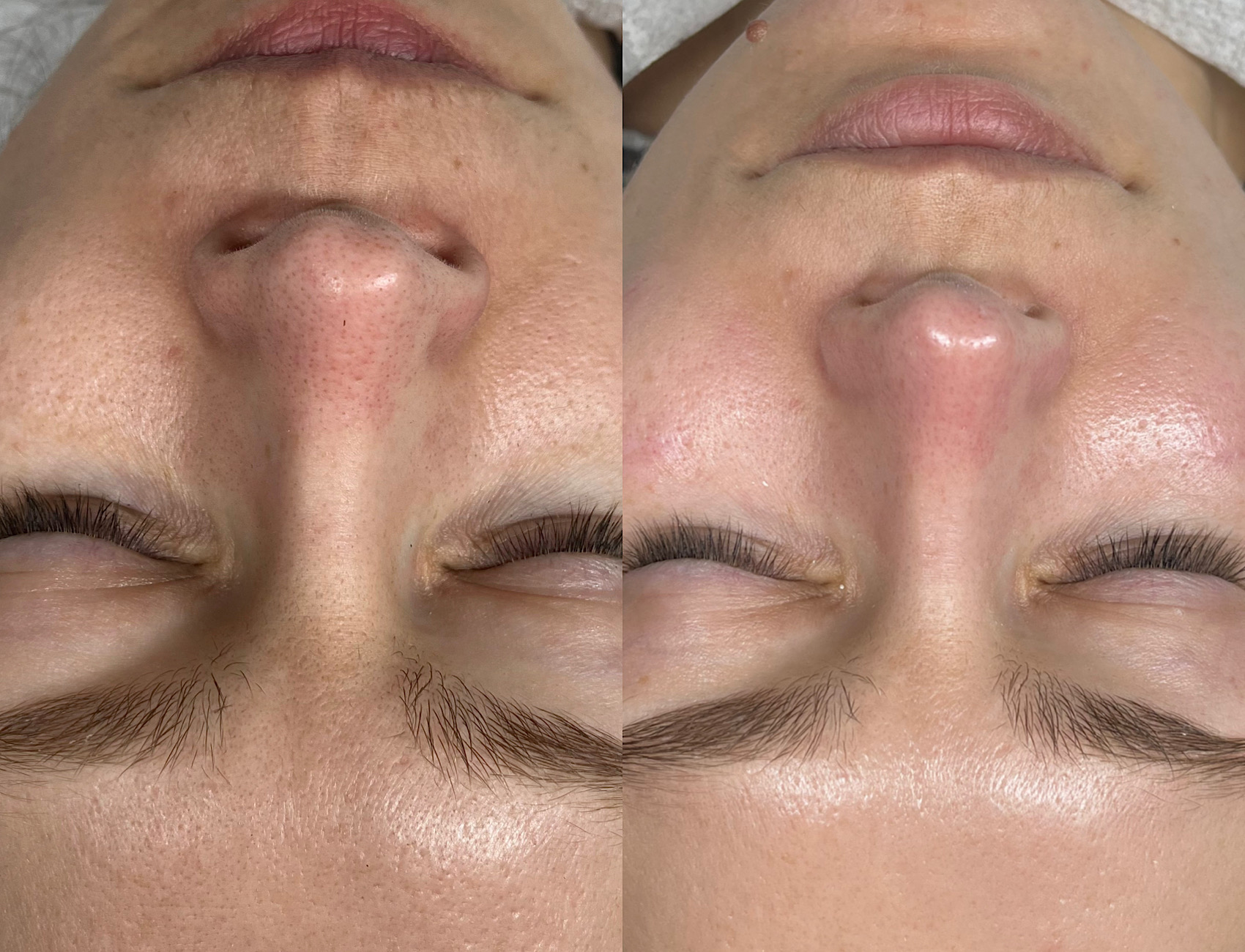 Personalized facial before and after comparison showing improved skin clarity