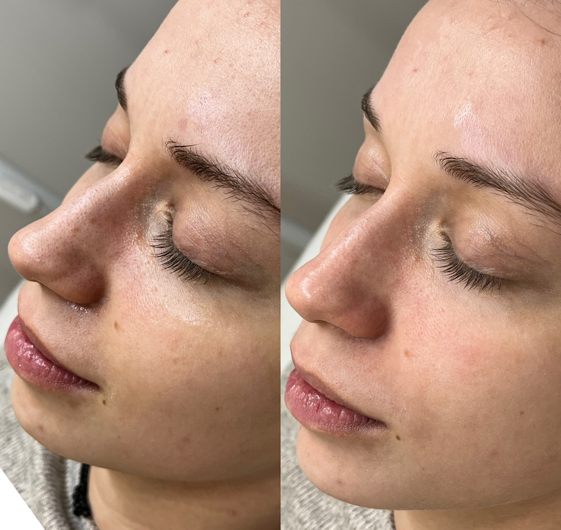 Personalized facial before and after comparison showing improved skin clarity