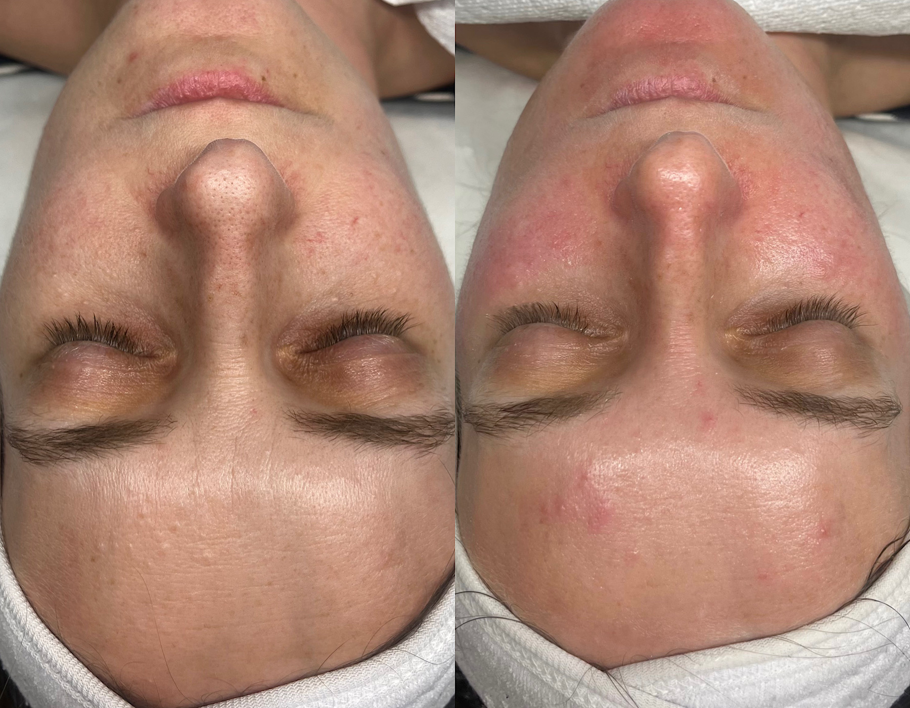 Personalized facial before and after comparison showing improved skin clarity