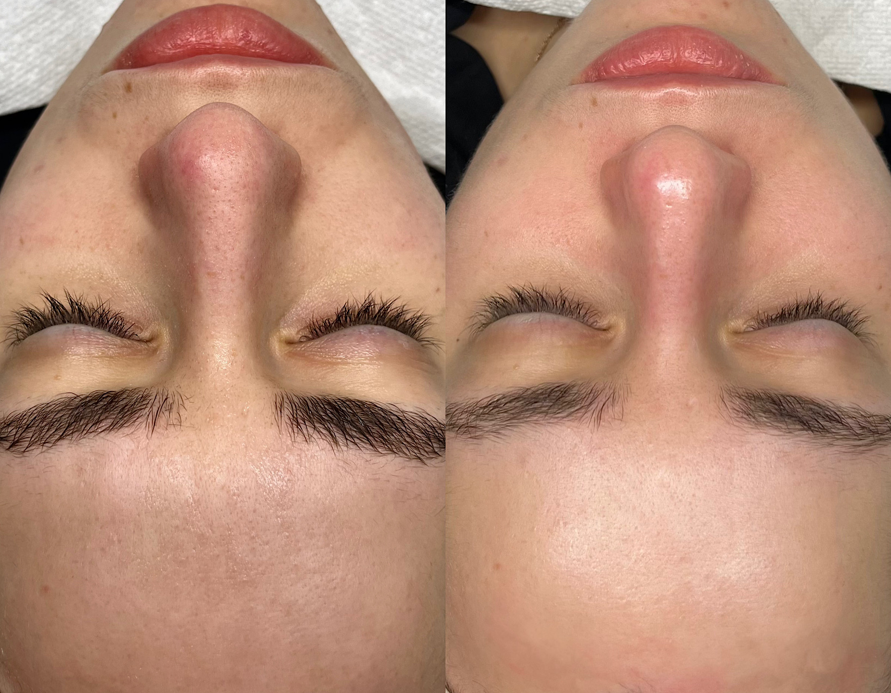 Personalized facial before and after comparison showing improved skin clarity