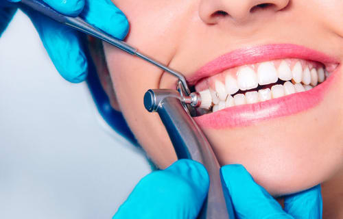 Teeth Cleaning (Scaling & Polishing)