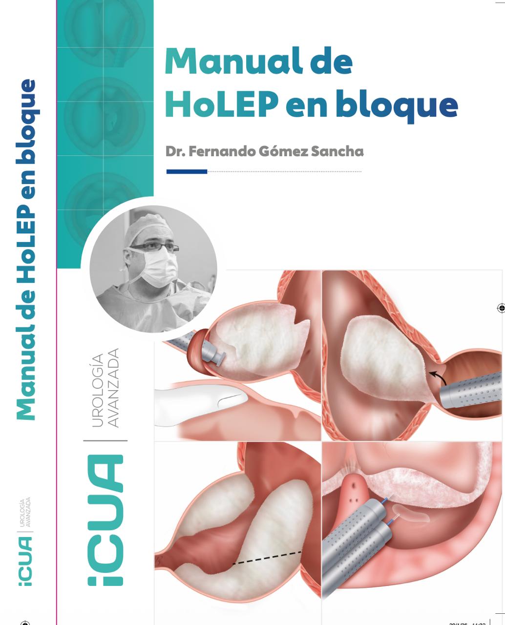 Manual HoLEP en Bloque