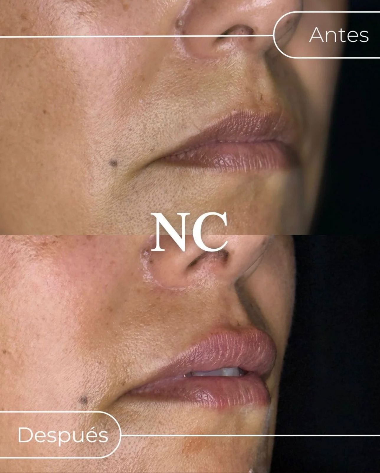Caso de armonización orofacial