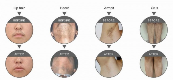 Laser hair removal logo