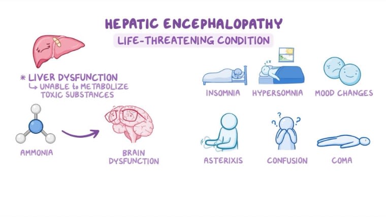 Graphic showing the cause and symptoms of hepatic encephalopathy, for which Xifaxan is often the prescribed