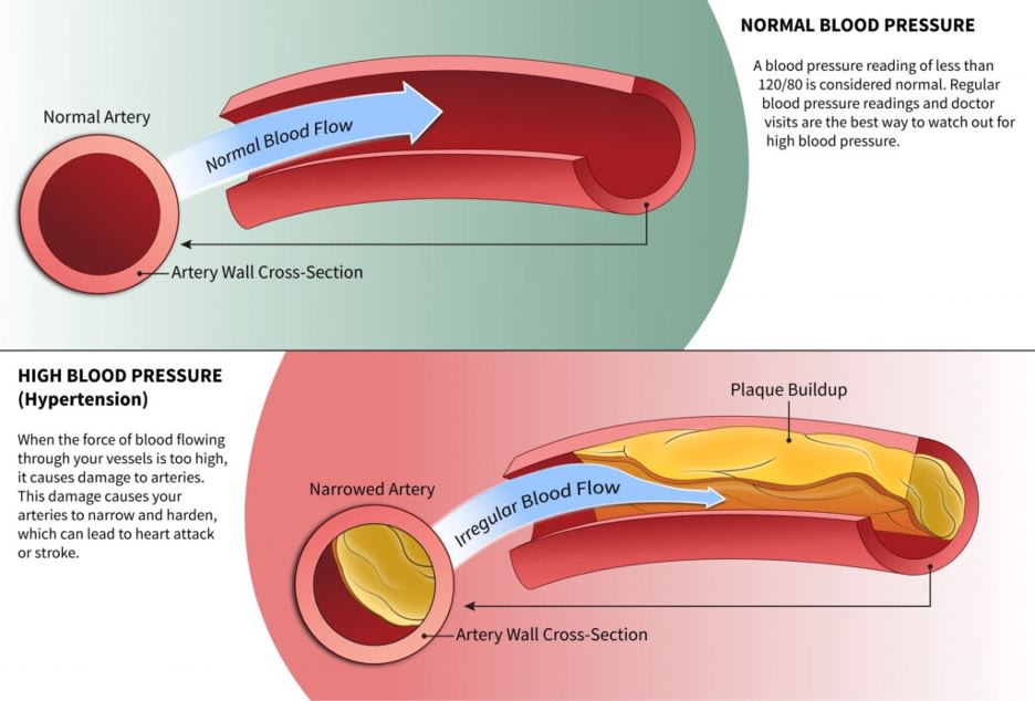 Graphic showing the difference between normal blood flow and irregular blood flow cause by high blood pressure