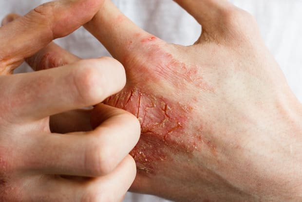 a hand with a skin rash