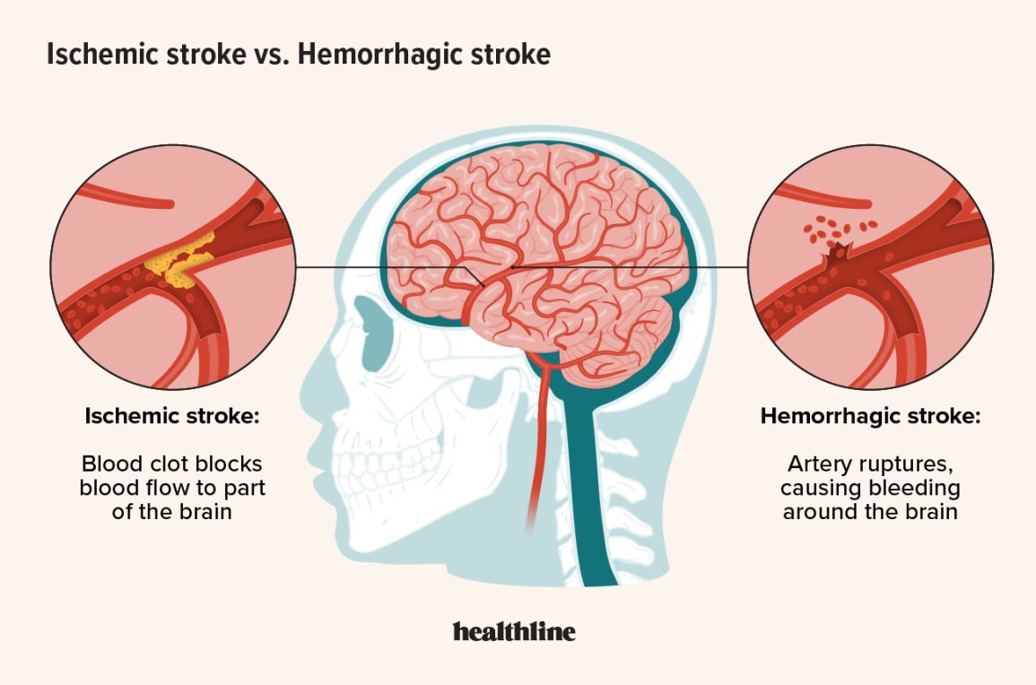 graphic showing the difference between ischemic and hemorrhagic stroke