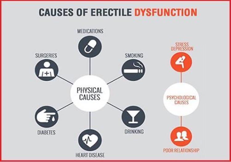 Graphic showing the physical and psychological causes of erectile dysfunction