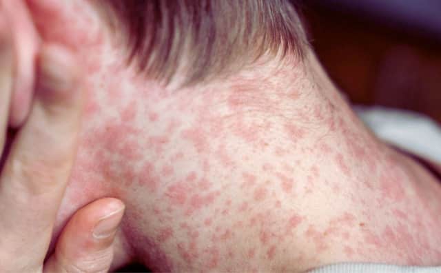 Bulgaristan'da Kızamık Alarmı: Vaka Sayısı 43'e Yükseldi, Çocuklar Risk Altında