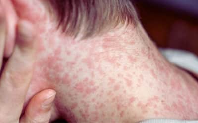 Bulgaristan'da Kızamık Alarmı: Vaka Sayısı 43'e Yükseldi, Çocuklar Risk Altında