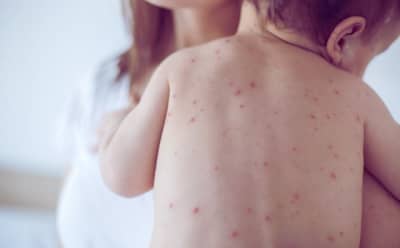 Bulgaristan'da Kızamık Alarmı: Vaka Sayısı 66'ya Yükseldi, Virüs Sofya'ya Sıçradı