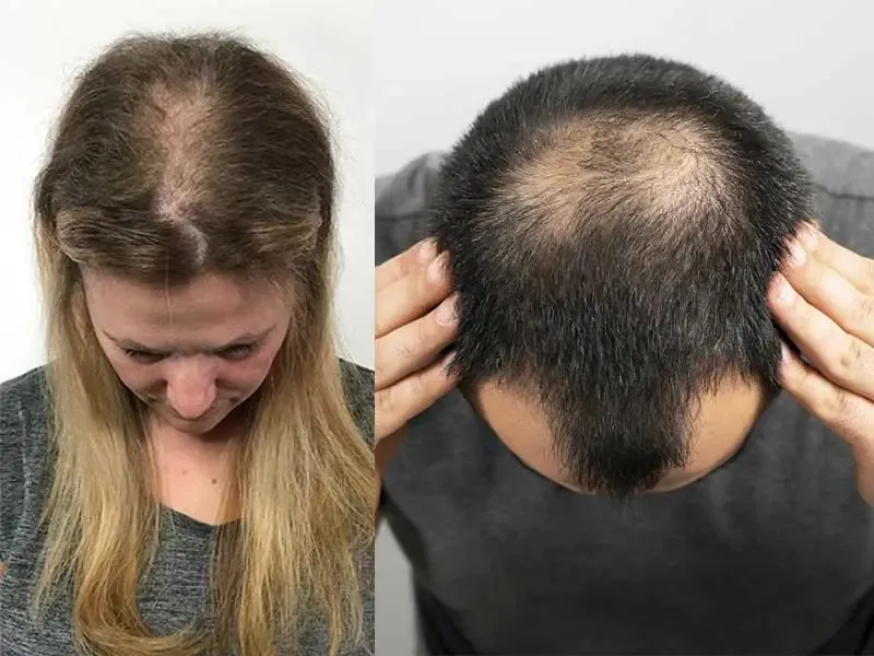 Featured image: बालों का झड़ना कैसे रोकें? (Balon Ka Jhadna Kaise Roke) | कारण, इलाज और असरदार उपाय