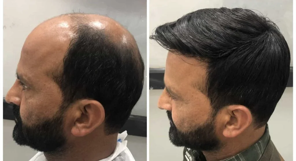 Featured image: Hair Patch Treatment in Delhi & Gurgaon | Your Complete Guide by Uncover Clinics
