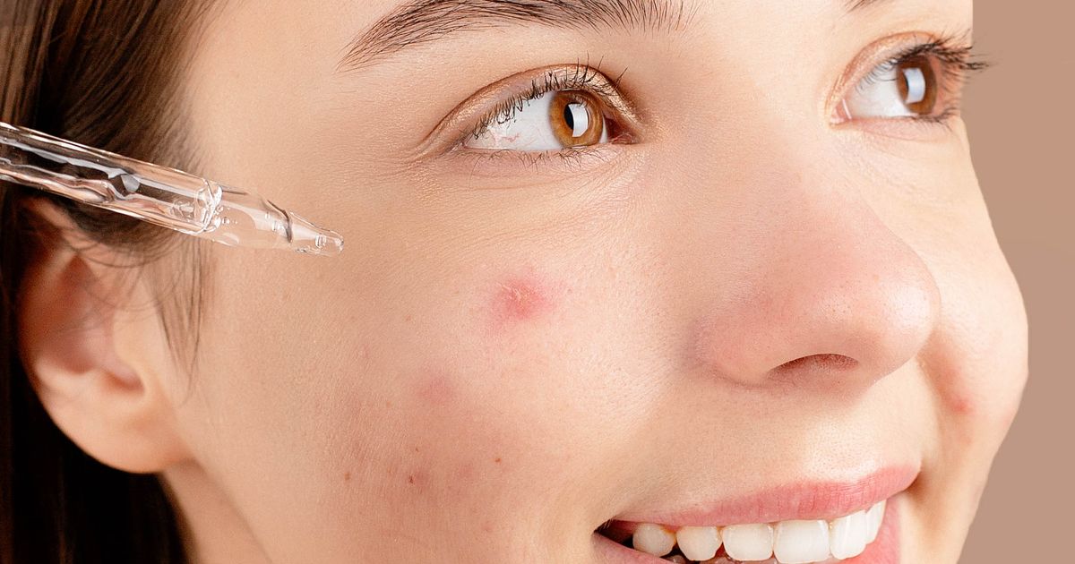 Mụn Nội Tiết — Nguyên Nhân & Cách Điều Trị Dứt Điểm