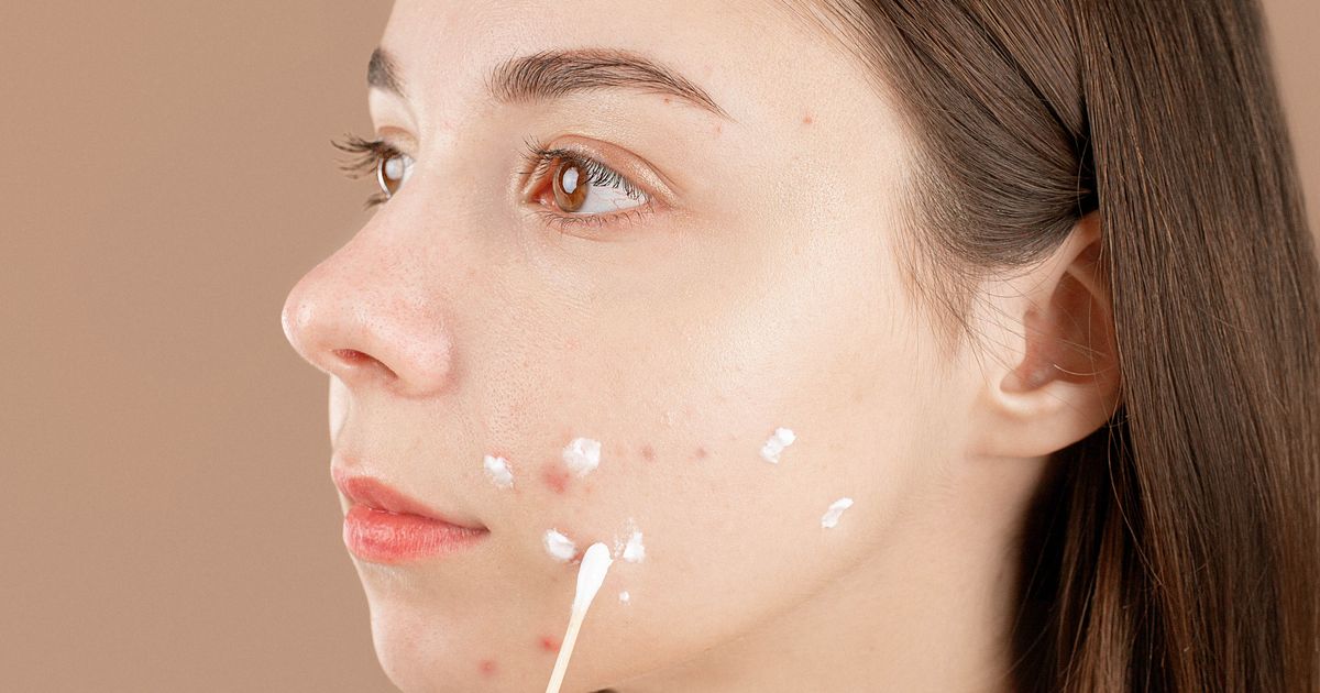 Isotretinoin (Accutane): Liệu Pháp Mụn Cuối Cùng - Rủi Ro & Lợi Ích