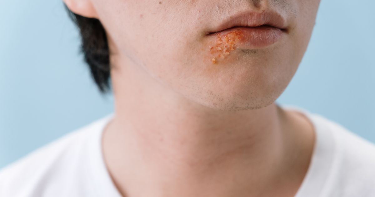 Nấm da mùa mưa: nhận biết các loại thường gặp và cách phòng trị hiệu quả