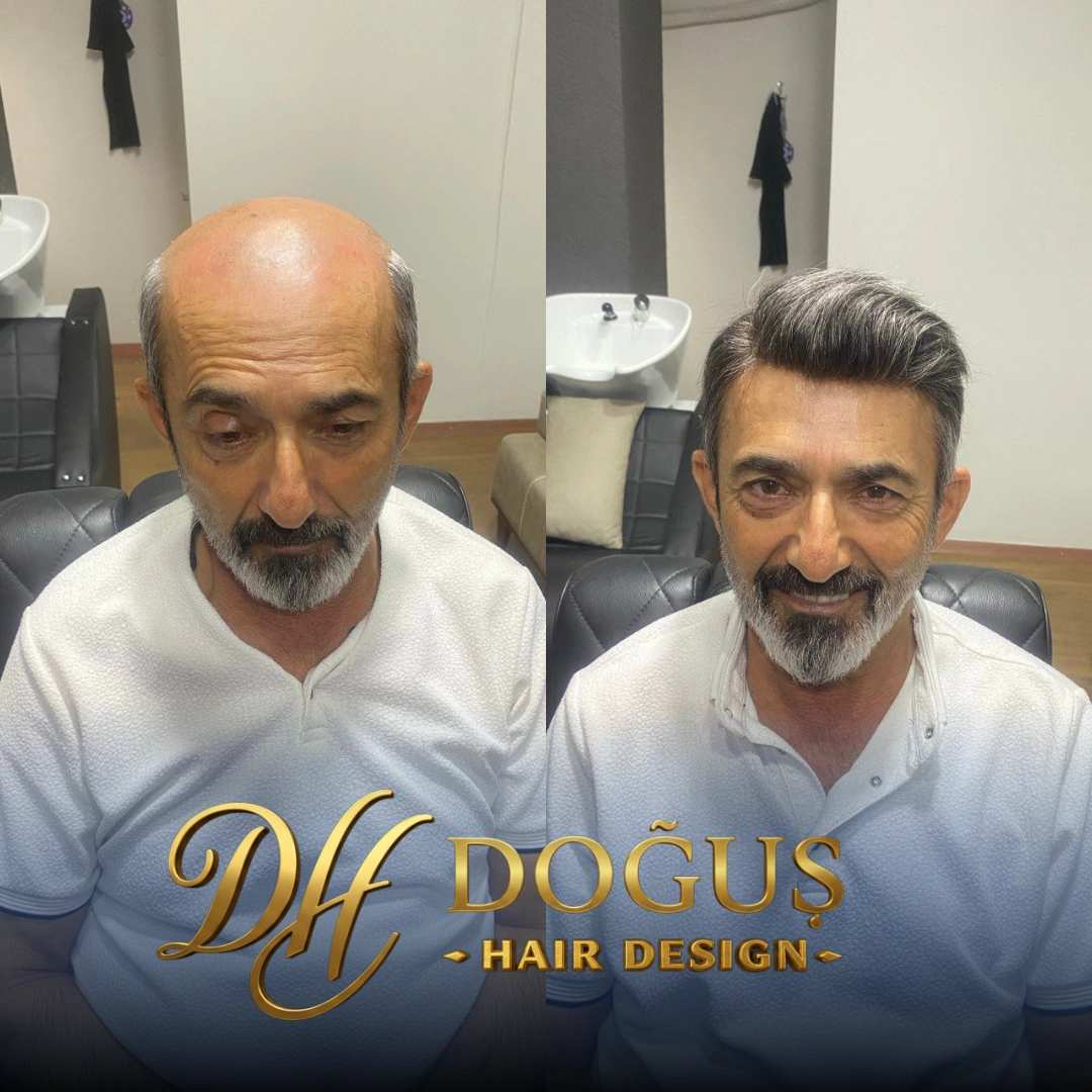 Protez Saç Hakkında 10 Şehir Efsanesi: Gerçekler ve Yanlışlar