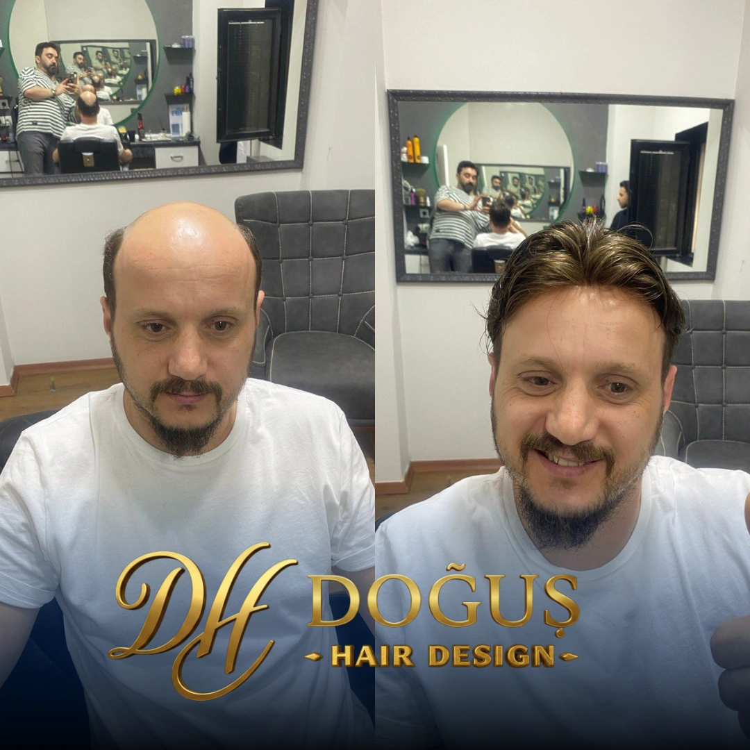 Protez Saç Ömrü Ne Kadar? Kullanım Süresini Uzatmanın 5 Altın Kuralı