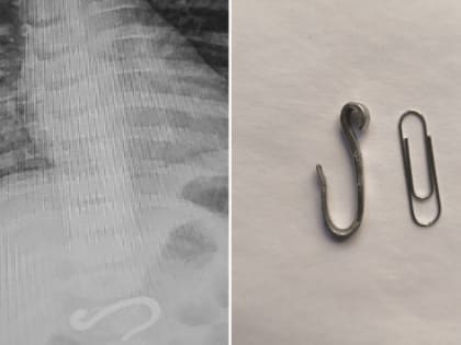 Необычное происшествие в Челябинске: малыш проглотил металлический крюк