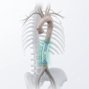 Aortic Surgery