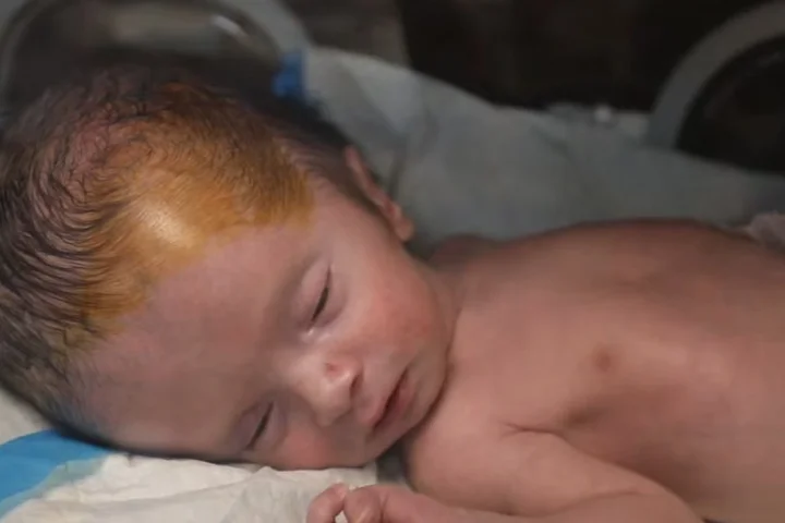 Gaza’s unseen casualties: A surge in stillbirths and birth defects