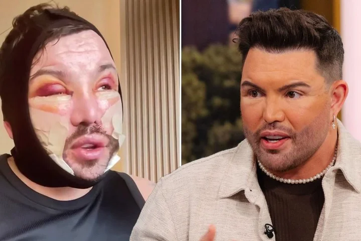 Bobby Norris reveals swollen facelift results as new video sparks confusion