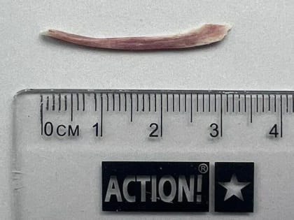 В Краснодаре хирурги вытащили куриную кость из пищевода пациента