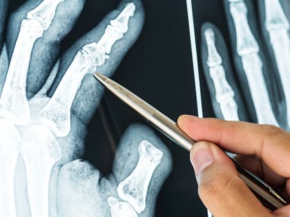 От подагры: травы, которые выведут мочевую кислоту, снимут воспаление и уберут боль