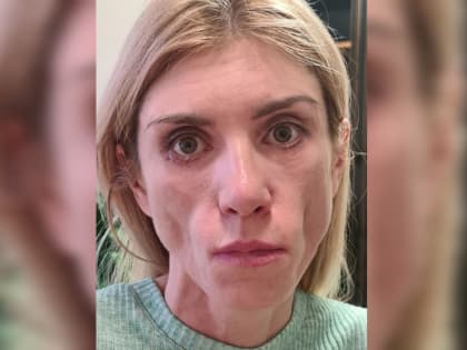 Бастрыкин запросил доклад по делу сочинки, изуродованной пластическим хирургом