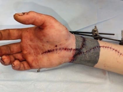 На Кубани врачи пришили мужчине отрубленную топором кисть