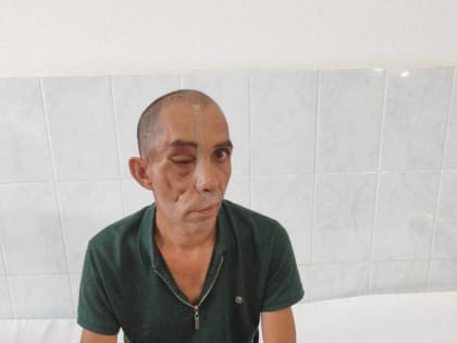 В Краснодаре человек потерял лицо из-за огромной опухоли