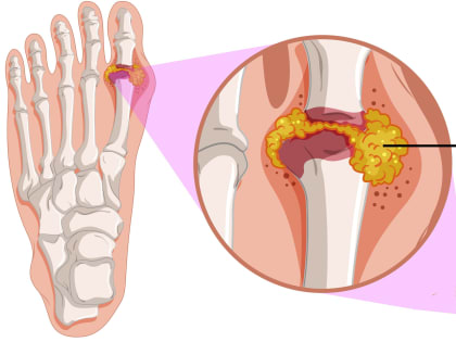 Если подагра разбушевалась: способы, которые вы должны попробовать, чтобы быстро облегчить боль