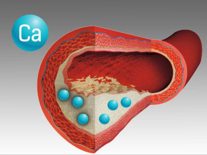 Кальцификация сосудов: причины, симптомы и способы борьбы с опасным недугом