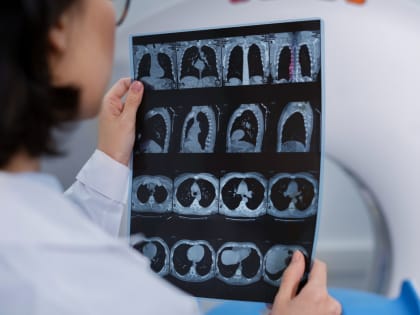 Рак легких: необычные признаки, которые могут указывать на онкологию