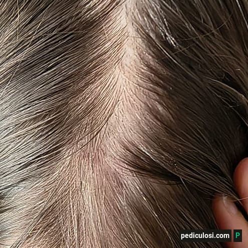 Foto verificata di lendini attaccate ai capelli, caso 5