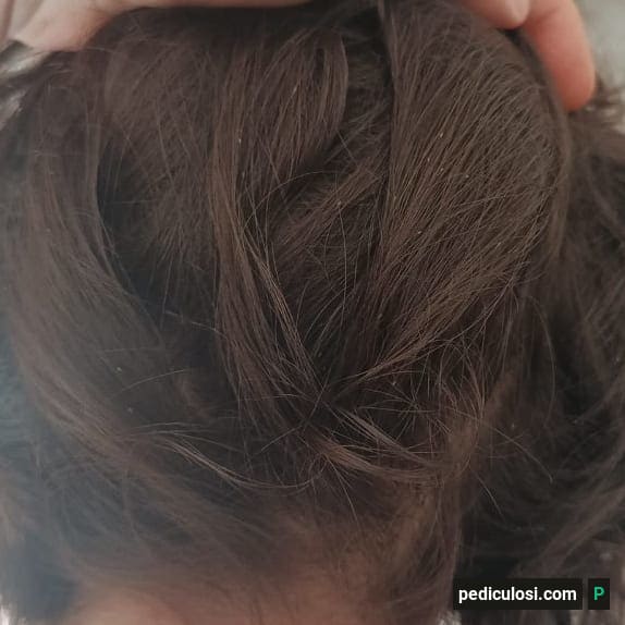 Foto verificata di lendini attaccate ai capelli, caso 15