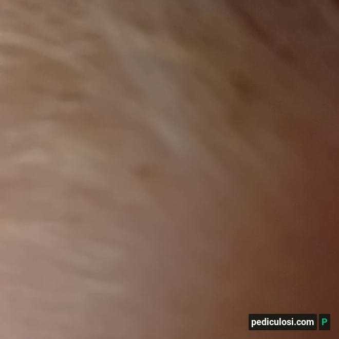 Foto verificata di lendini attaccate ai capelli, caso 6