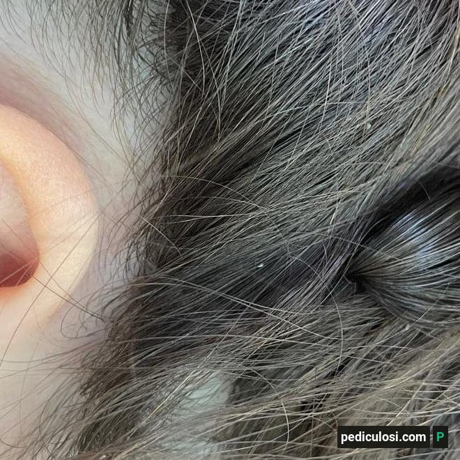 Foto verificata di lendini attaccate ai capelli, caso 22