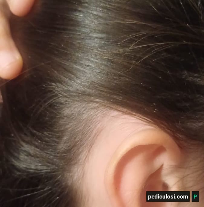 Foto verificata di lendini attaccate ai capelli, caso 8