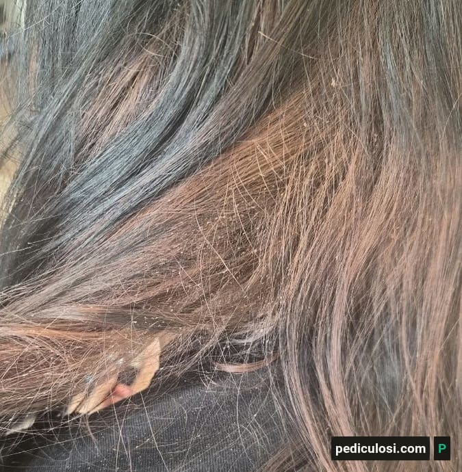 Foto verificata di lendini attaccate ai capelli, caso 14
