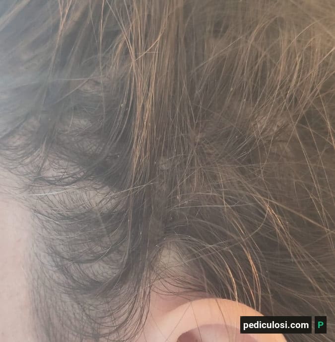 Foto verificata di lendini attaccate ai capelli, caso 20