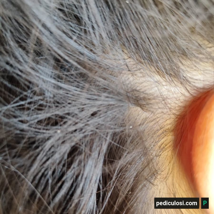 Foto verificata di lendini attaccate ai capelli, caso 19