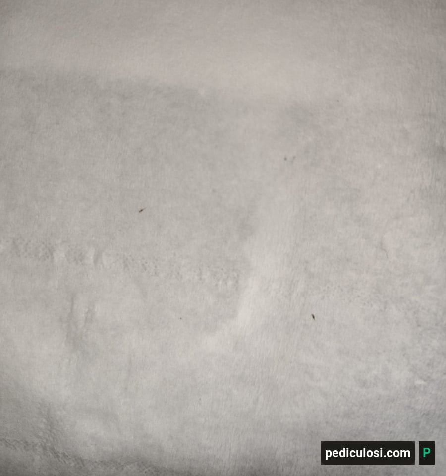 Foto verificata di lendini attaccate ai capelli, caso 18