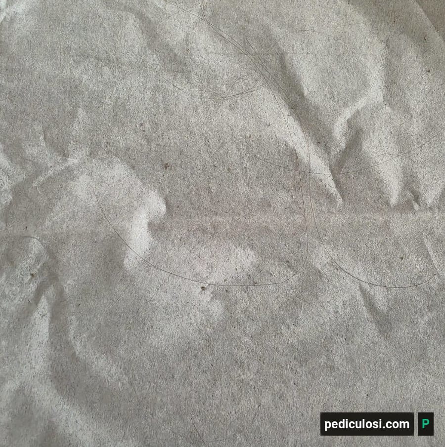 Foto verificata di lendini attaccate ai capelli, caso 24