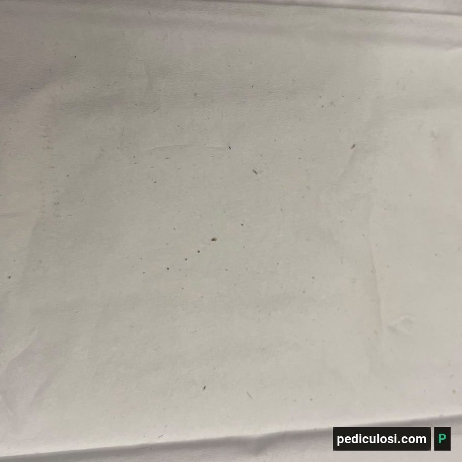 Foto verificata di lendini attaccate ai capelli, caso 23
