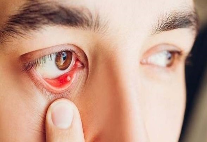 Cảm giác cộm mắt như có cát, đừng coi thường tín hiệu nhỏ này