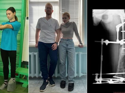 Самарские медики на 15 см удлинили ногу девочке-подростку с врожденным пороком развития
