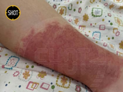 Подросток из Мытищ заболел рожей