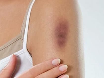 Почему появляются синяки на теле?